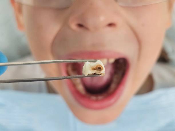 Best Emergency Root Canal Treatment in Santa Fe, TX