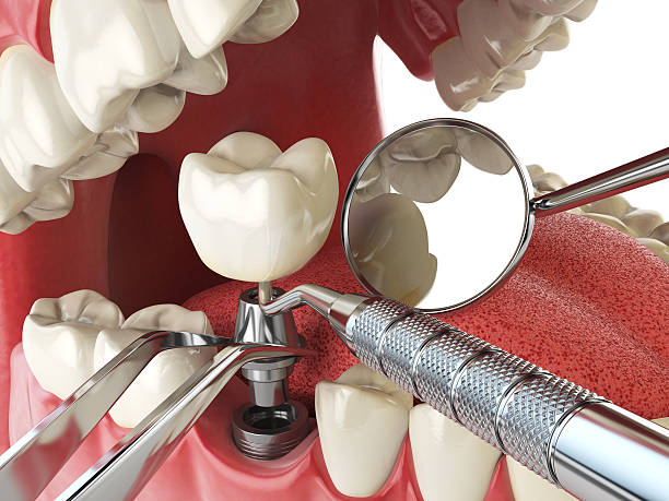 Best Emergency Tooth Extraction in Santa Fe, TX